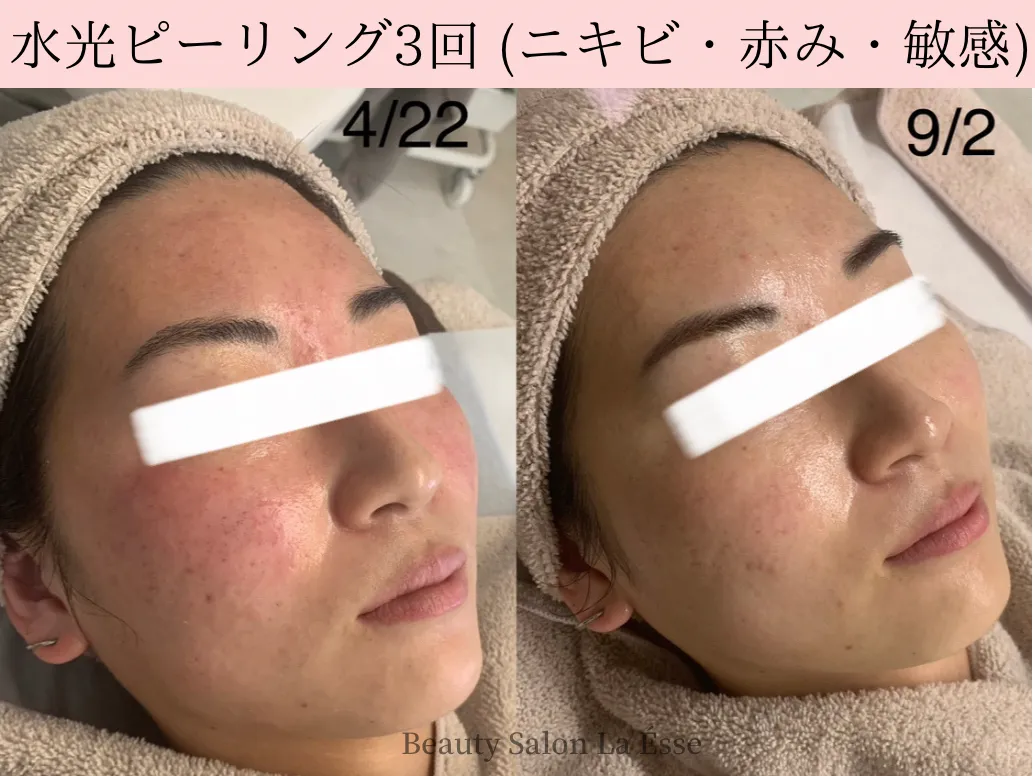 【水光ピール｜肌質改善・ニキビ肌】