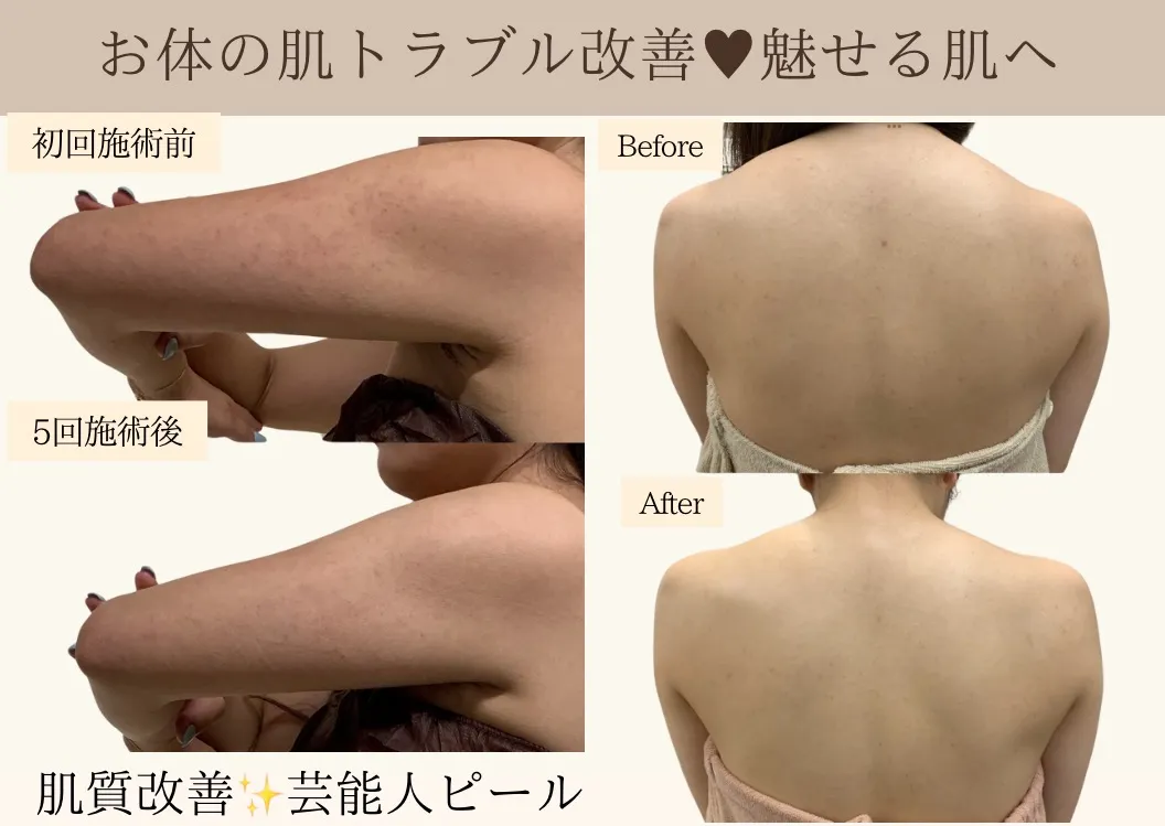 1部位パック¥1,100 背中｜うで｜デコルテ｜ヒップ