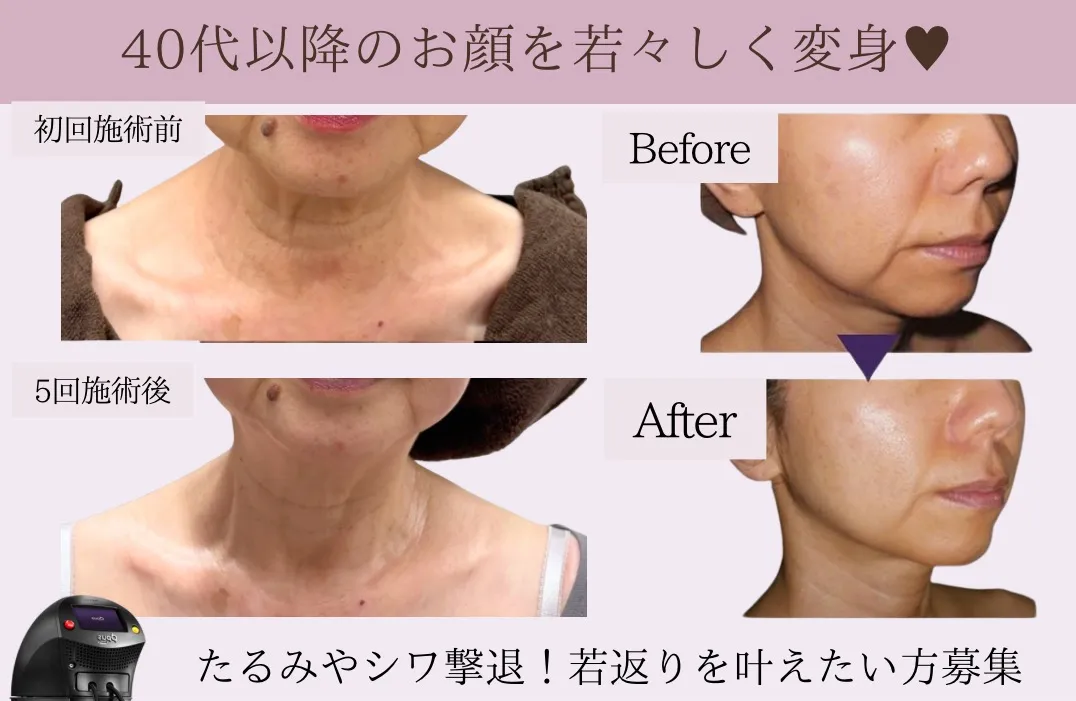 40代以降のお顔・首のお悩み解決