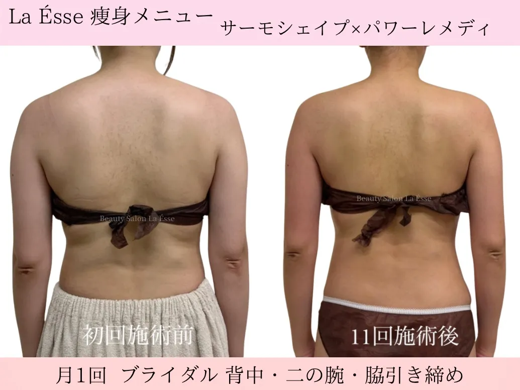 【ブライダル・背中痩せ】