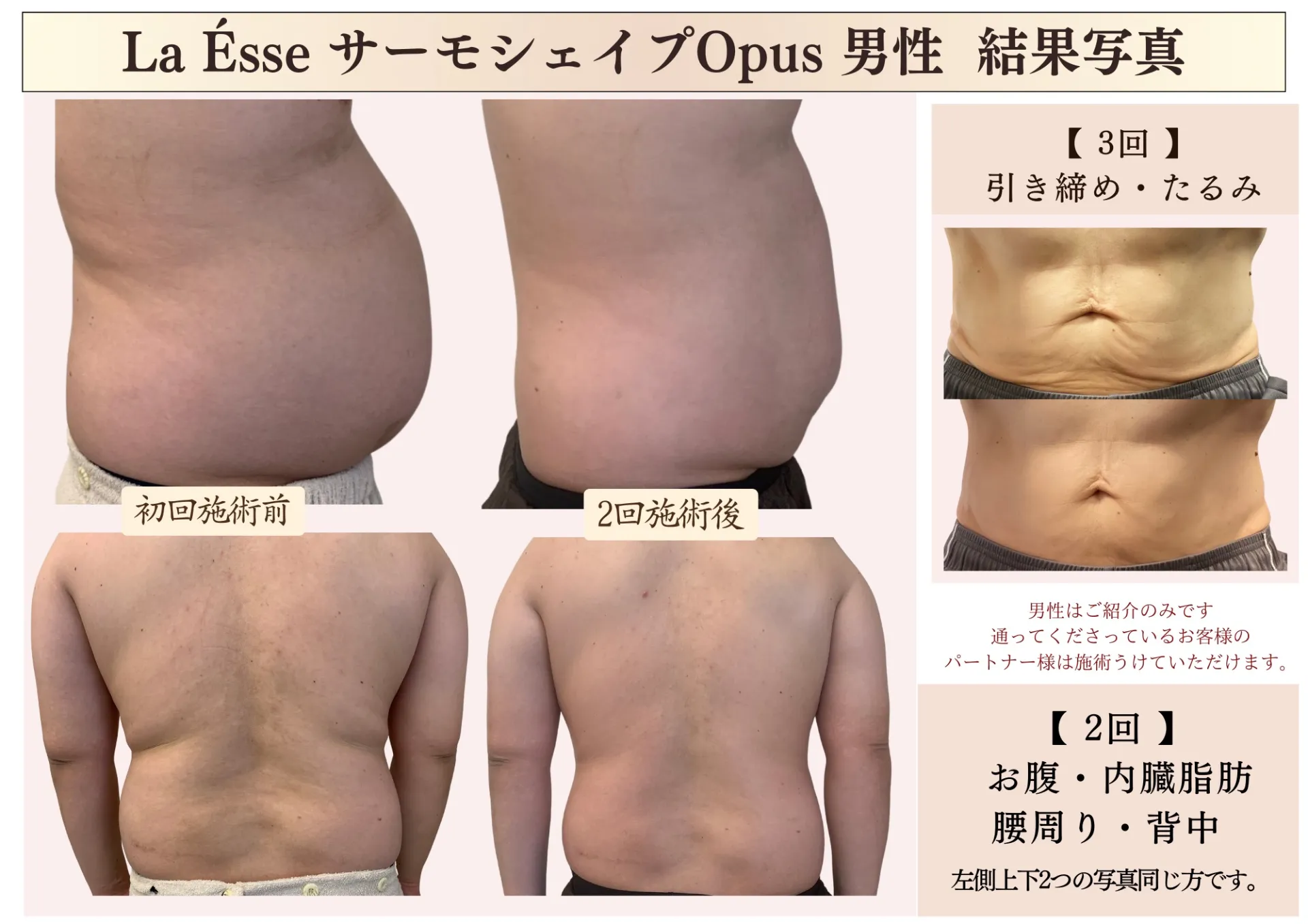 【ご紹介のみ｜男性痩身・サイズダウン】