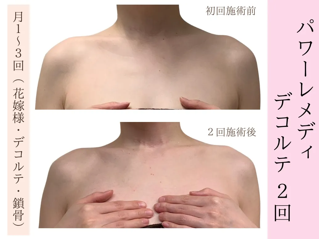 【ブライダル｜デコルテ｜姿勢改善】