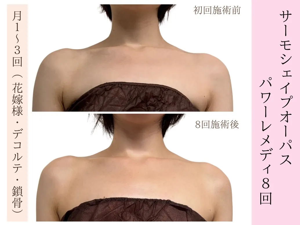 【ブライダル｜デコルテ｜姿勢改善】