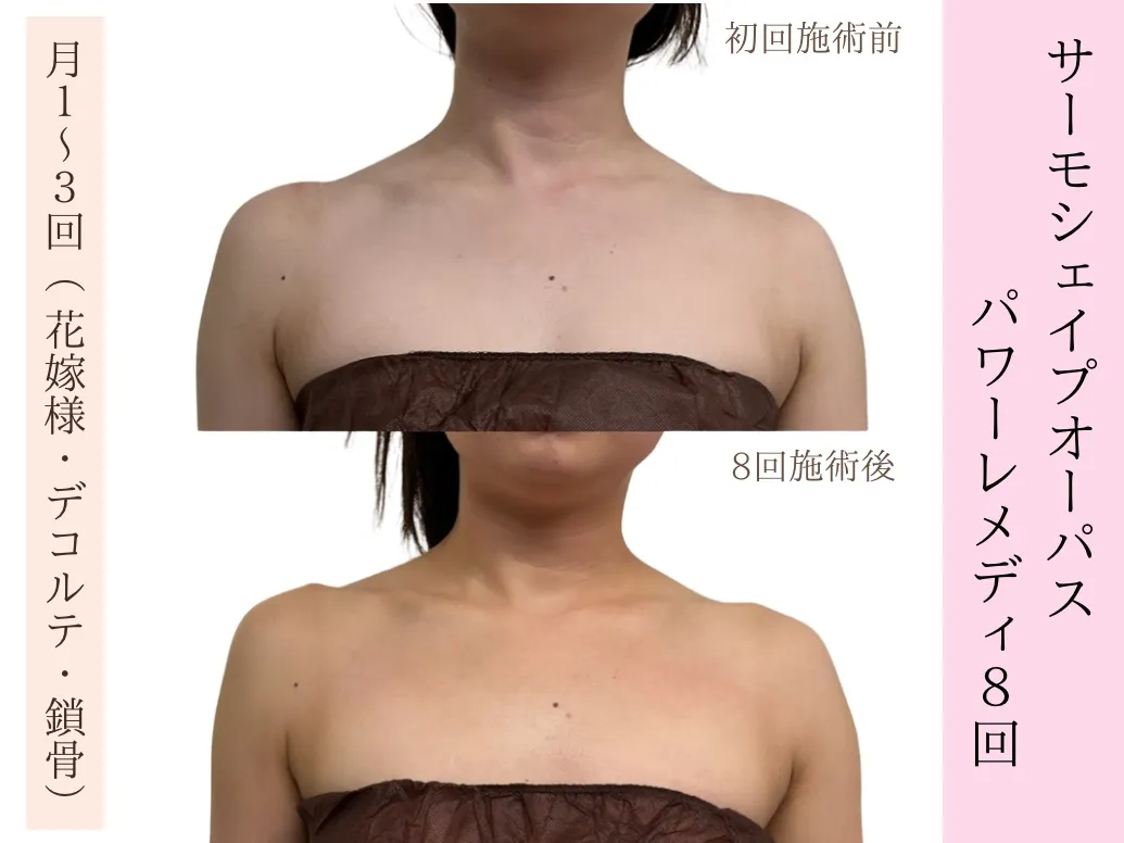 【ブライダル｜デコルテ｜姿勢改善】