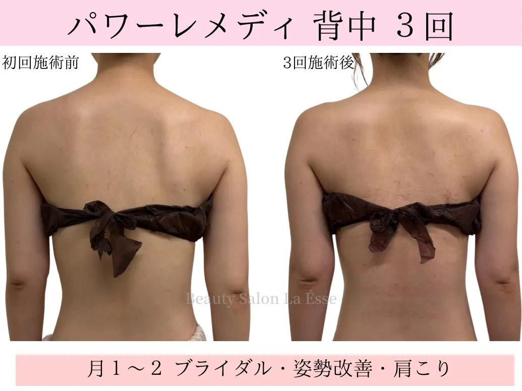 【ブライダル・背中痩せ】