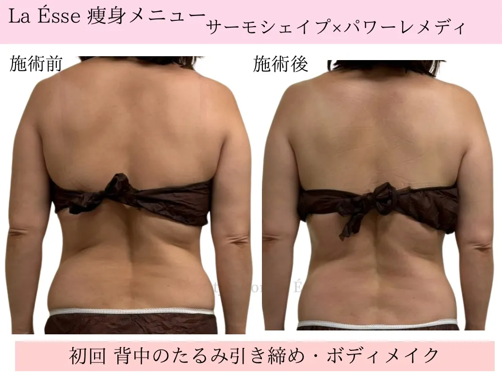 【ブライダル・背中痩せ】