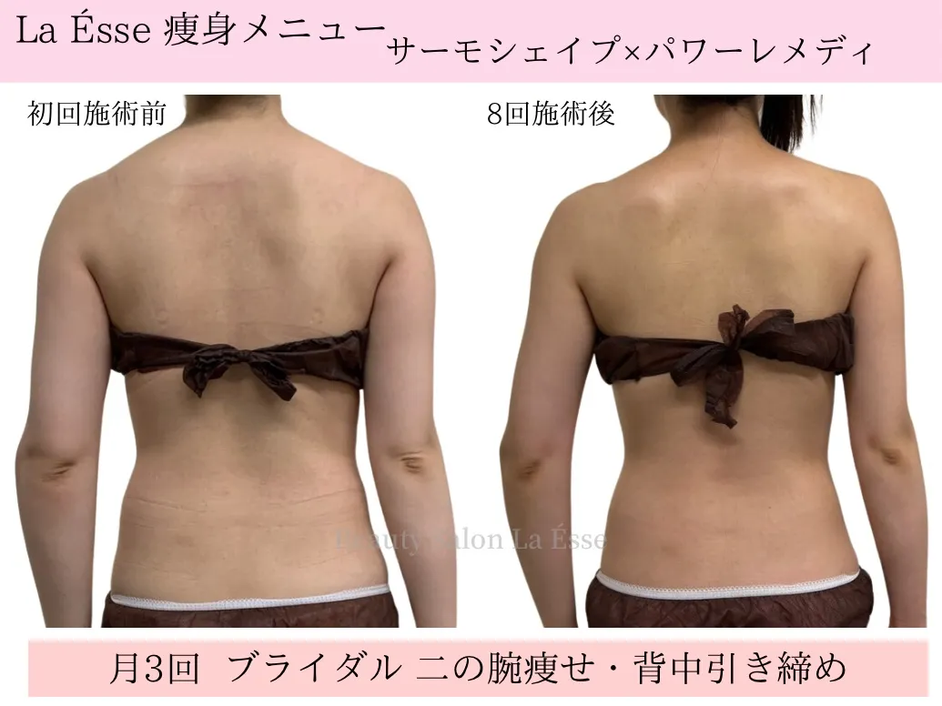 【ブライダル・背中痩せ】