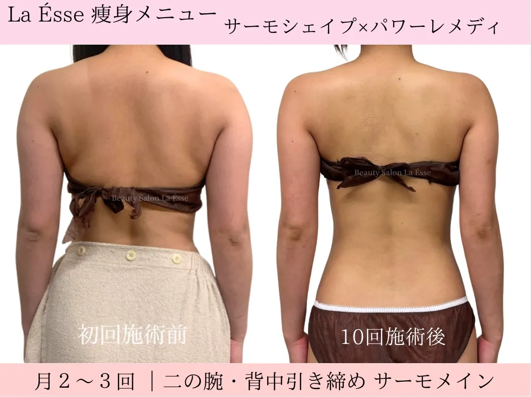 【ブライダル・背中痩せ】