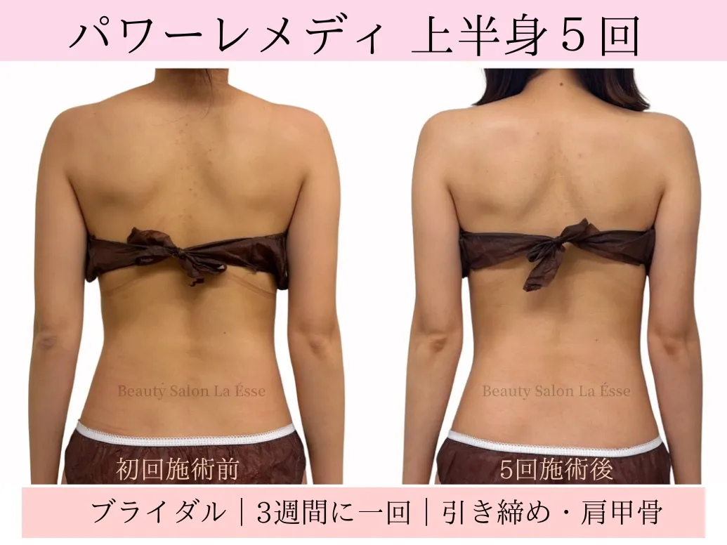 【ブライダル・背中痩せ】