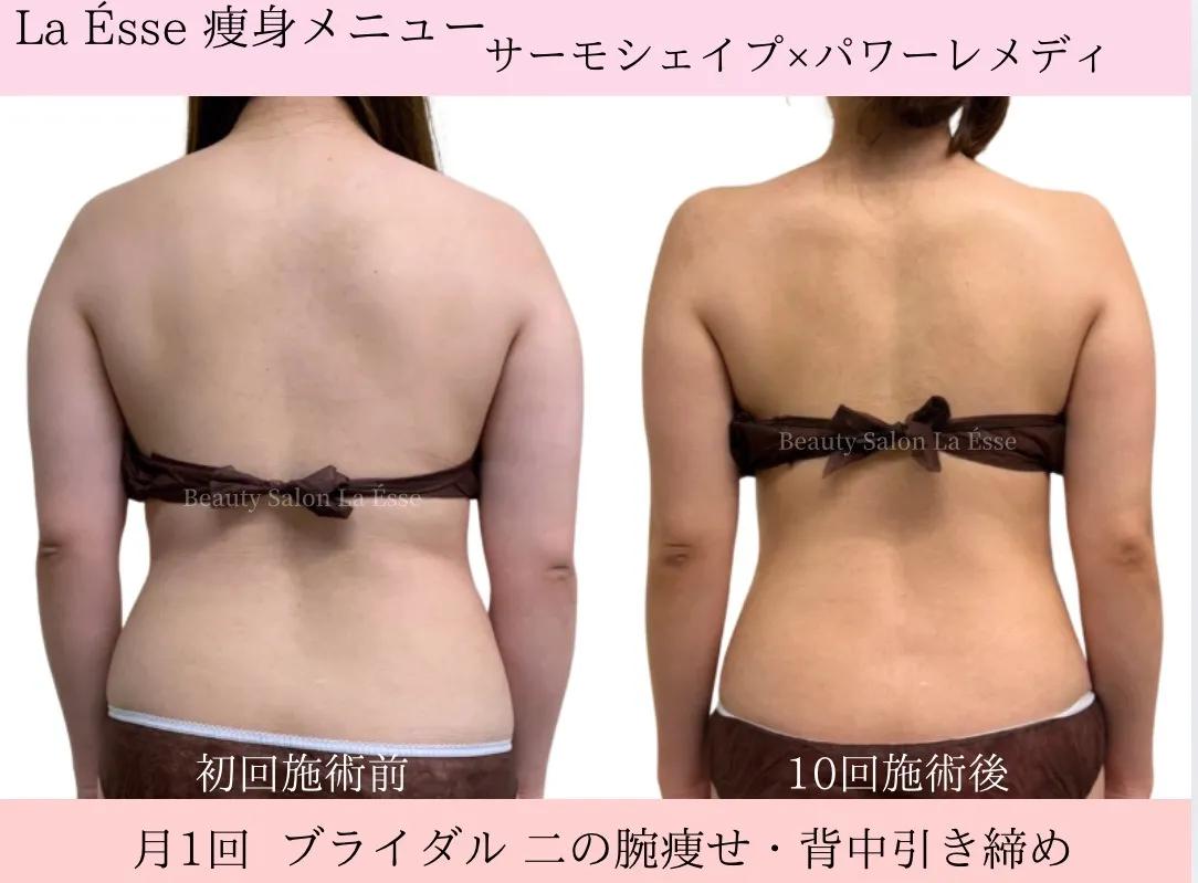 １ヶ月に１回ブライダルエステ💎施術×運動の相乗効果で別人級に👏🏻✨  