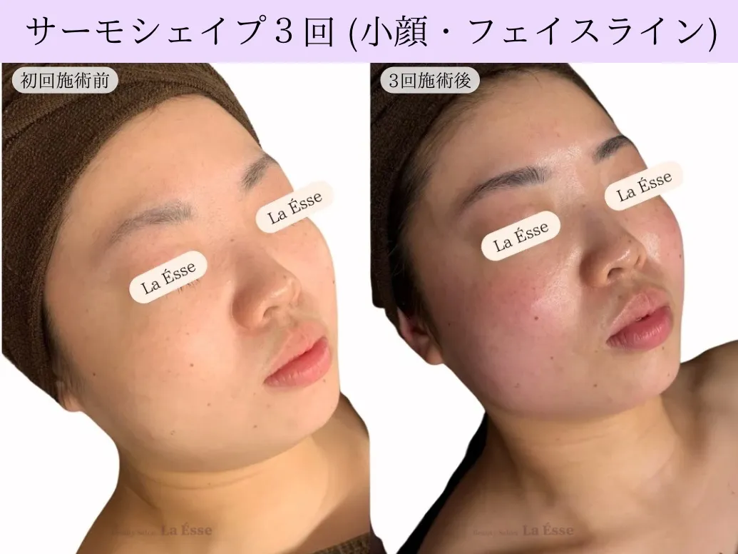 【小顔・たるみケア サーモシェイプ】