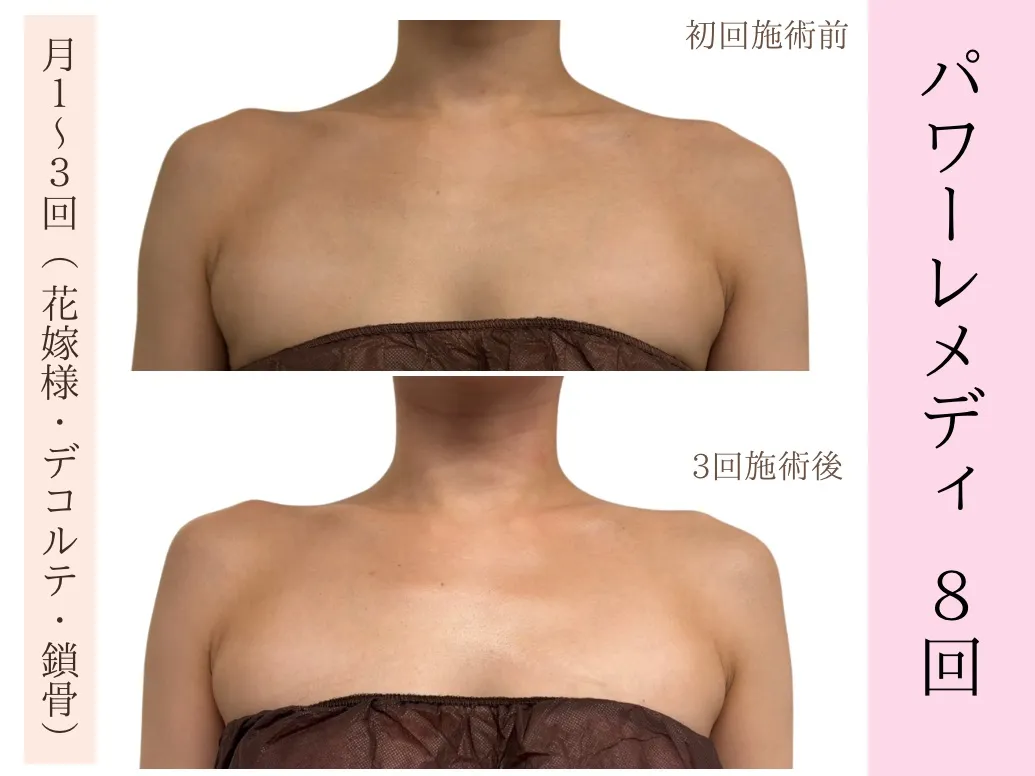 【ブライダル｜デコルテ｜姿勢改善】