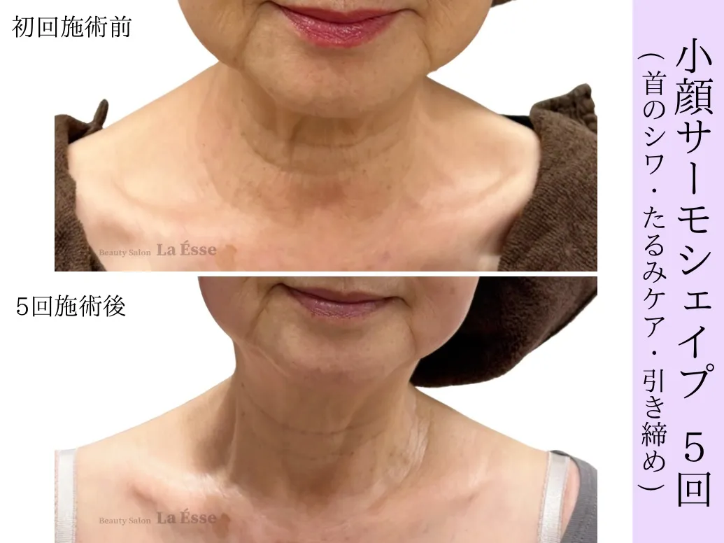 【小顔・たるみケア サーモシェイプ】