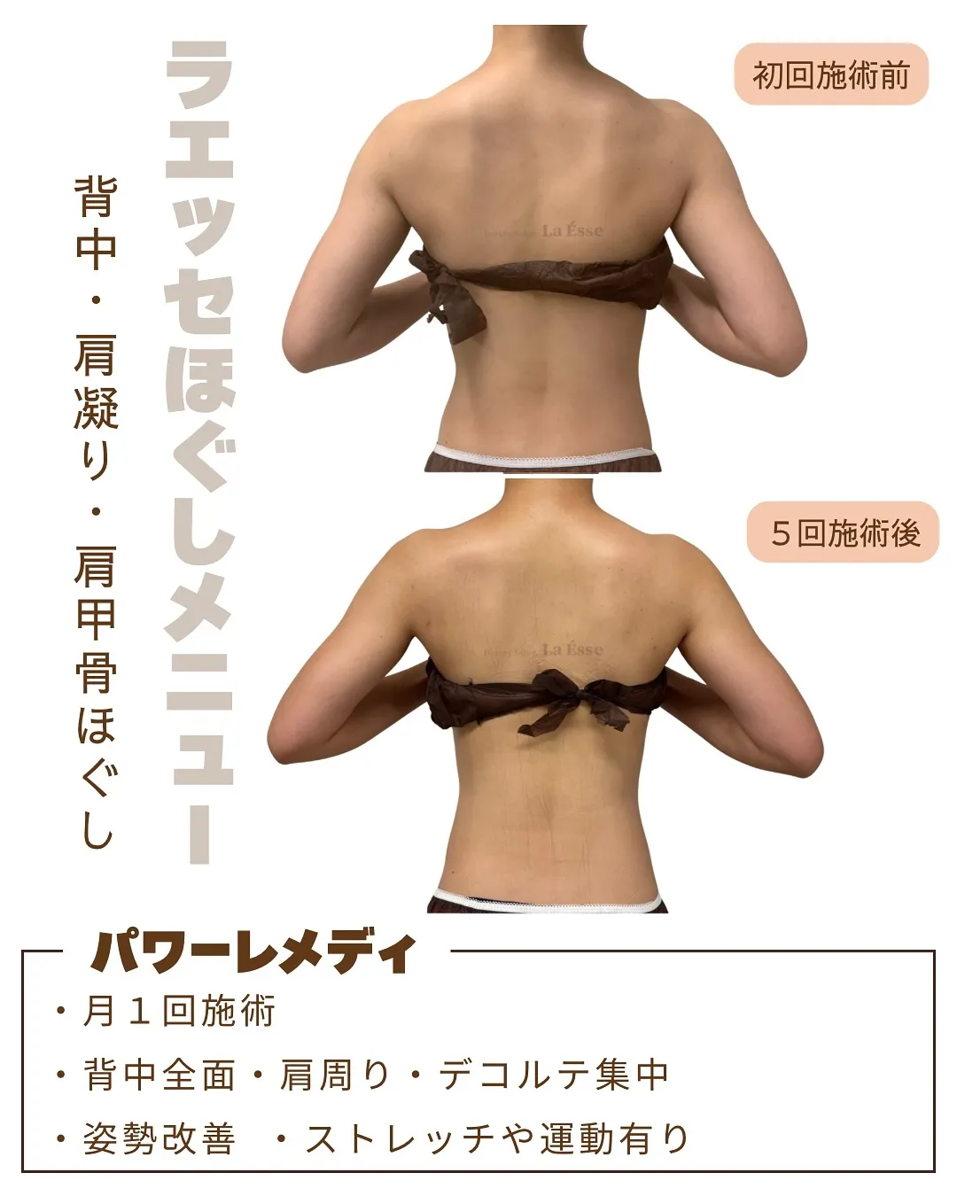 肩のもっこりなくしたい方!極上筋膜リリースで肩ボト💉卒業へ🤭