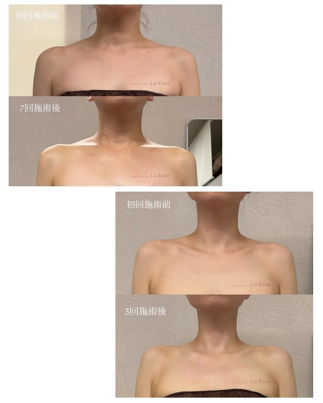 憧れのデコルテライン𝐆𝐄𝐓!!! 肩のもっこり撃退👊🏻💥