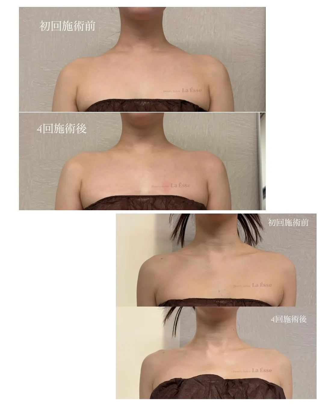 憧れのデコルテライン𝐆𝐄𝐓!!! 肩のもっこり撃退👊🏻💥