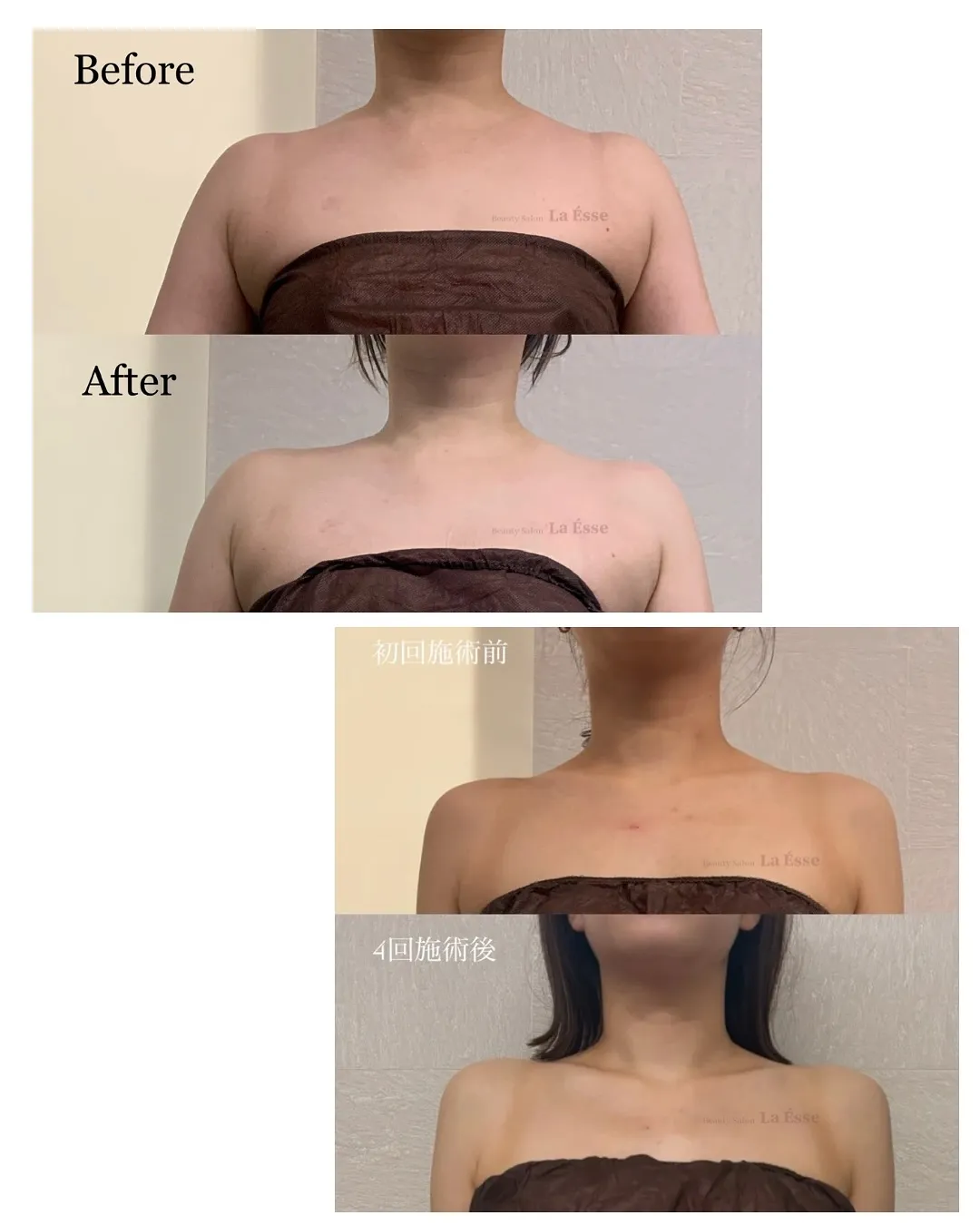 憧れのデコルテライン𝐆𝐄𝐓!!! 肩のもっこり撃退👊🏻💥