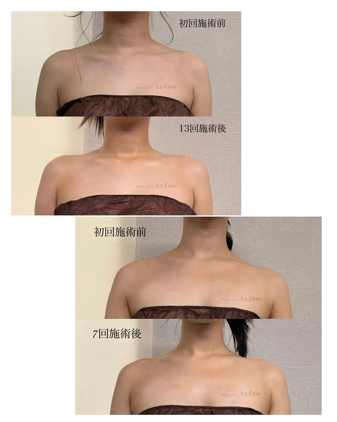 憧れのデコルテライン𝐆𝐄𝐓!!! 肩のもっこり撃退👊🏻💥