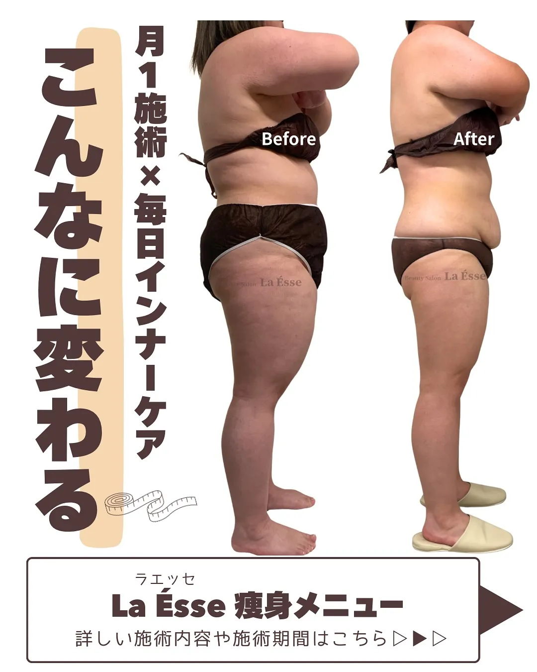 月1回施術×ホームケアでこんなに変わる！💪🏻 ボコボコ肌もも...