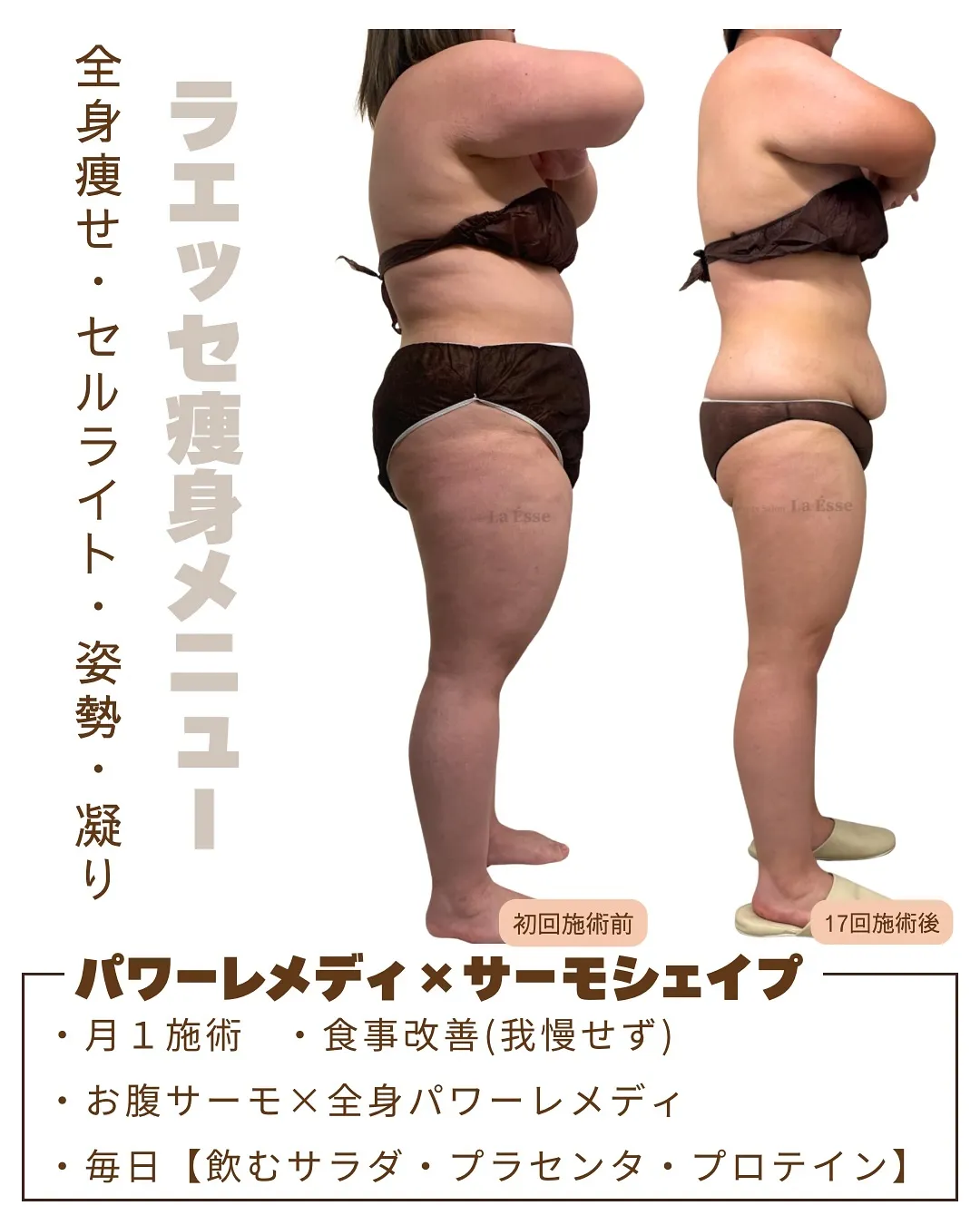 月1回施術×ホームケアでこんなに変わる！💪🏻 ボコボコ肌もも...