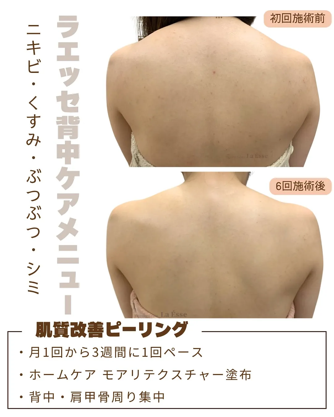 背中のお肌トラブル改善✨ ニキビやシミ・毛孔性苔癬無くしたい...