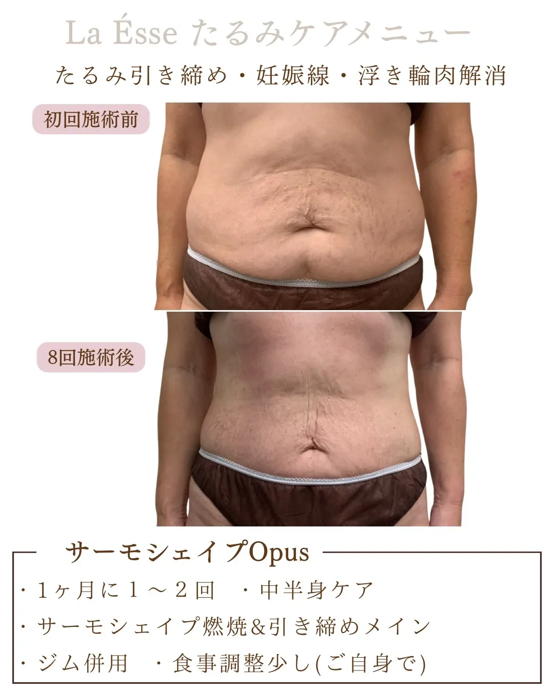 産後のお腹のたるみ放置してた方！そんな方は業界最高峰の高周波...