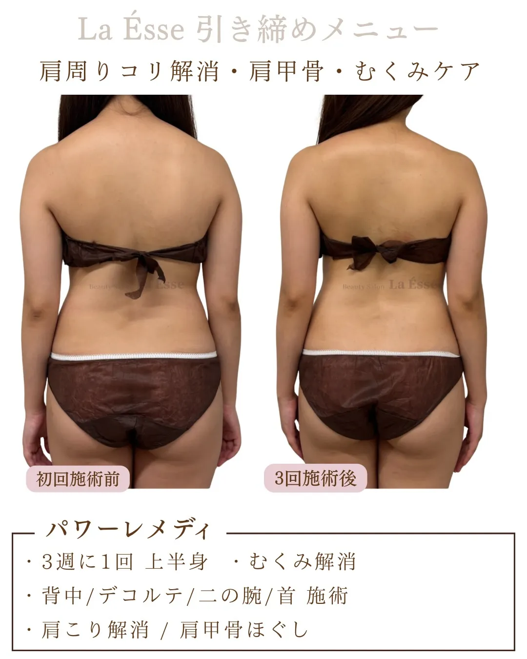 肩周りのもっこり解消！！華奢見えボディへ✨