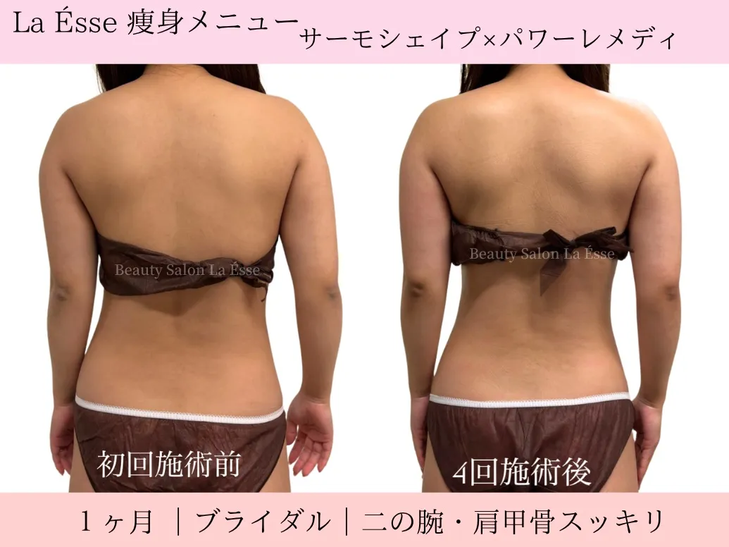 【ブライダル・背中痩せ】