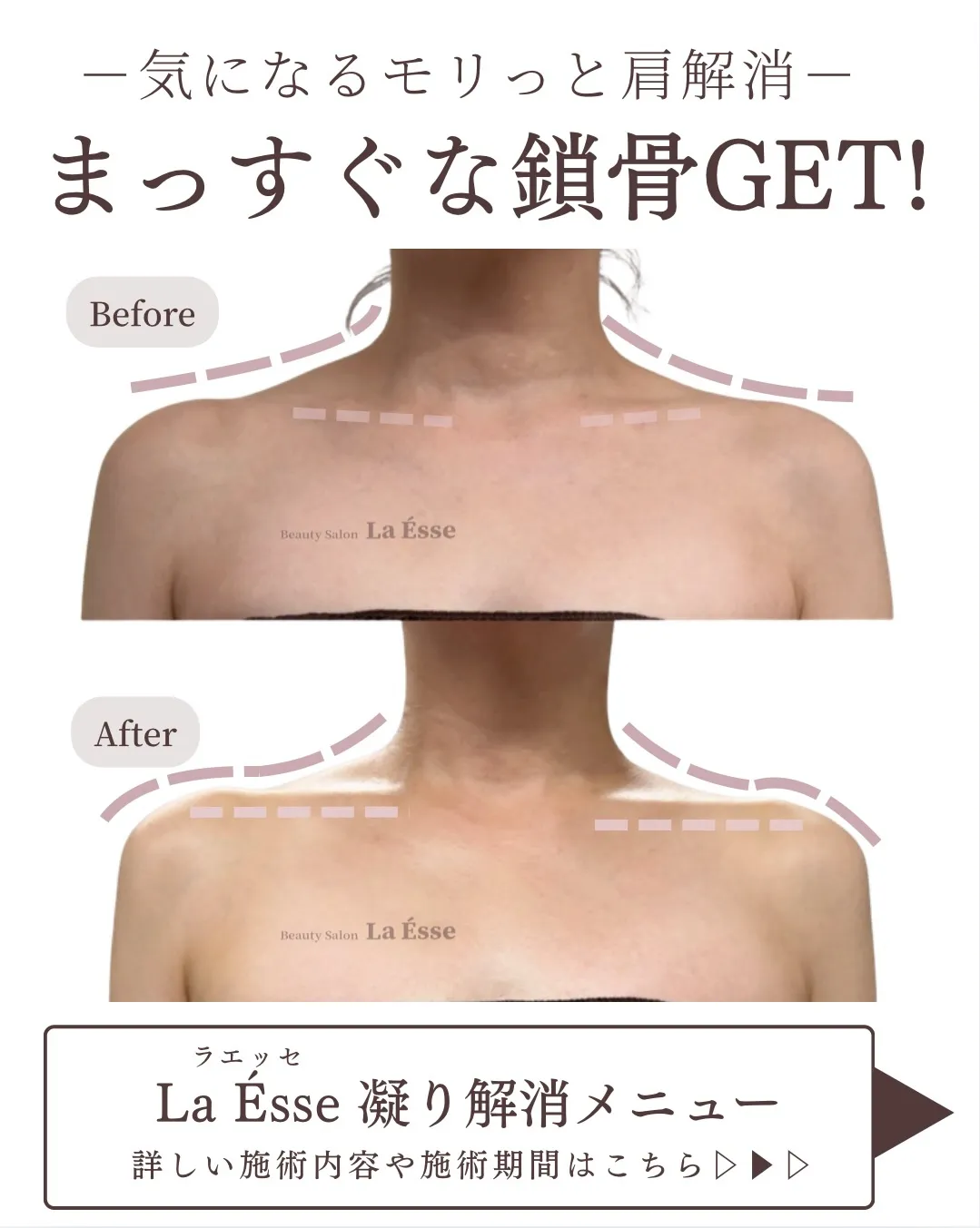 モリっとした肩から卒業💎自信が持てるデコルテへ💪🏻