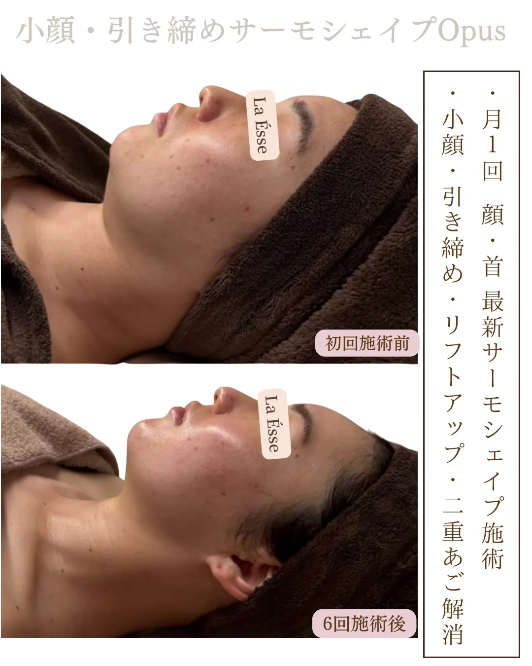 120%おすすめのフェイシャル施術！どこからみても美しいお顔...