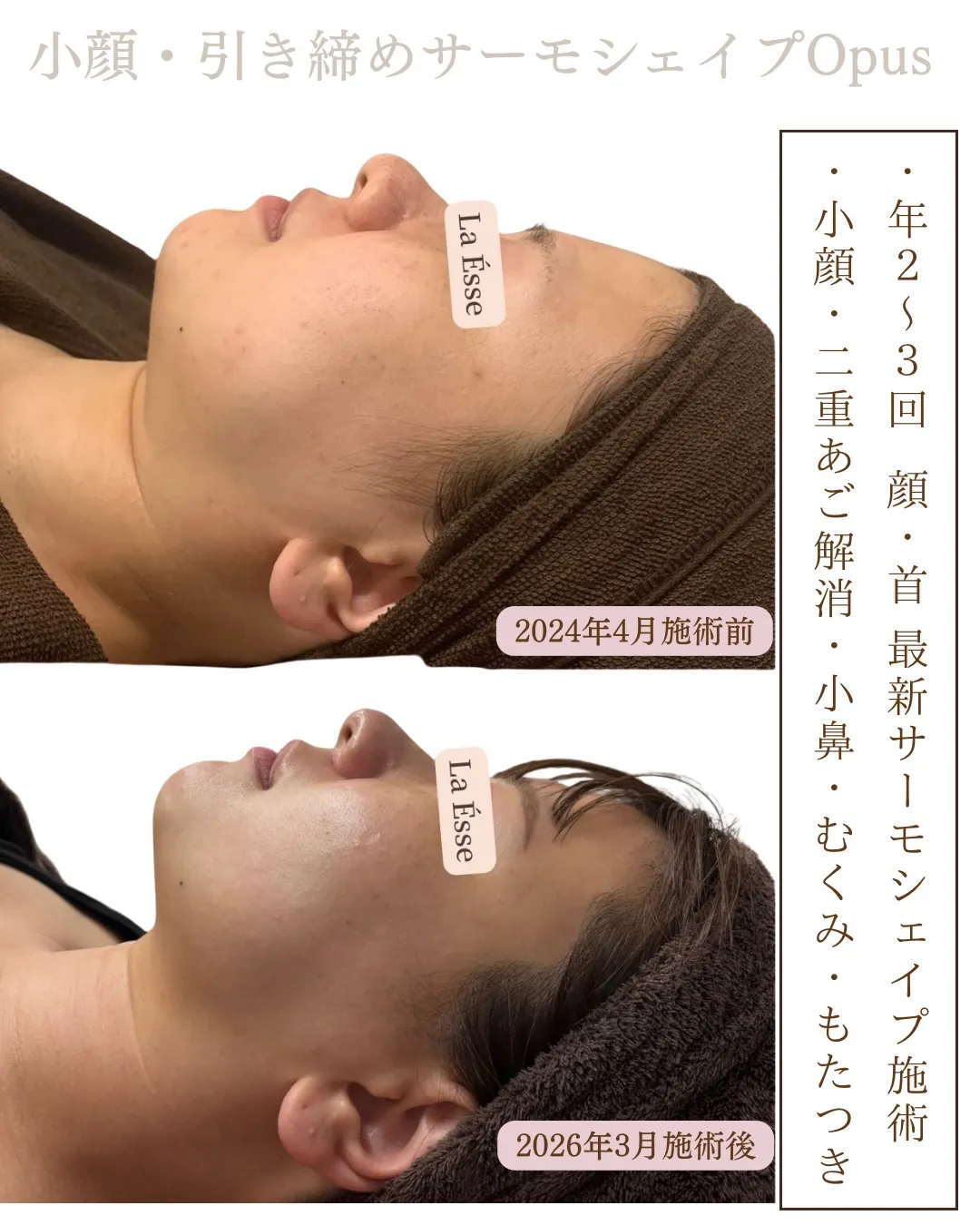 120%おすすめのフェイシャル施術！どこからみても美しいお顔...