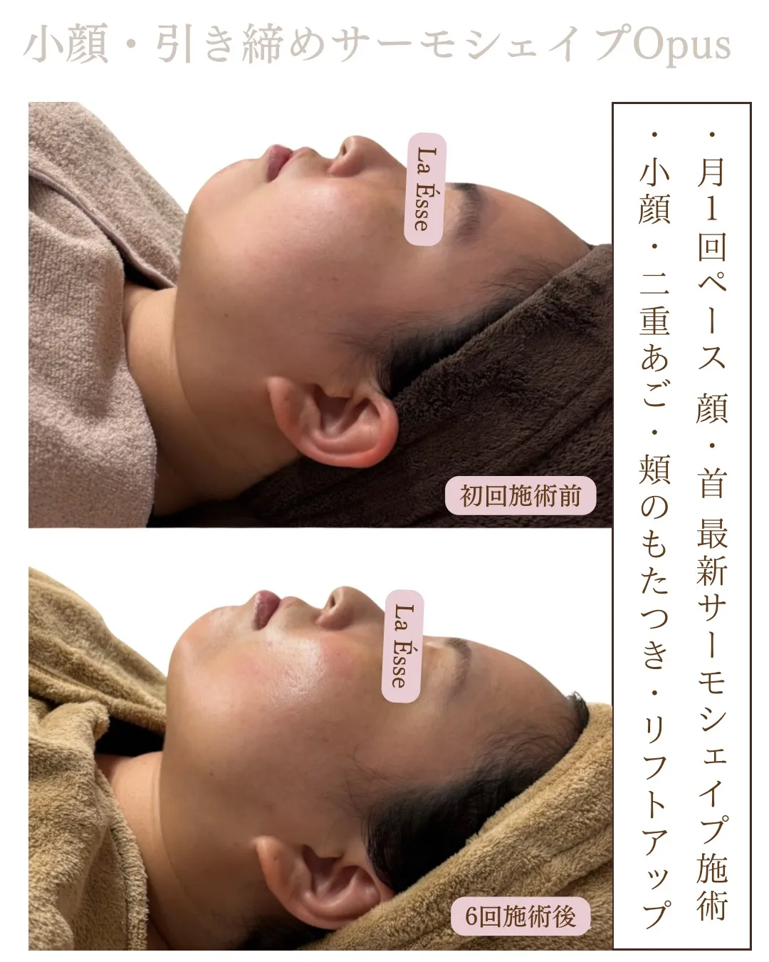 120%おすすめのフェイシャル施術！どこからみても美しいお顔...