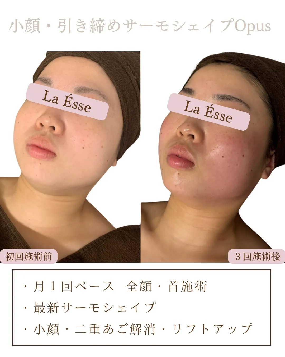 120%おすすめのフェイシャル施術！どこからみても美しいお顔...