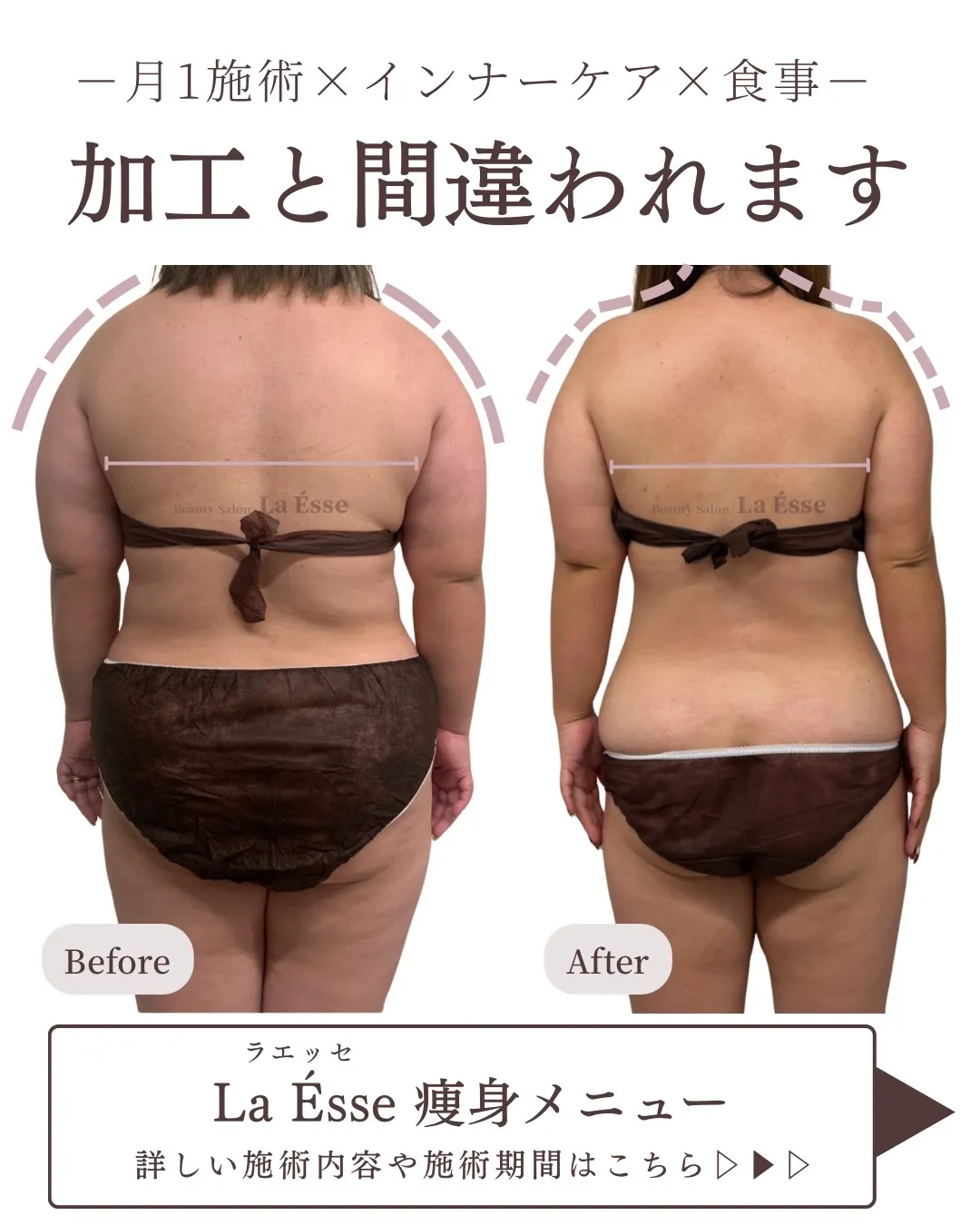 後ろ姿別人！！月1回施術で加工レベルに変われます✨