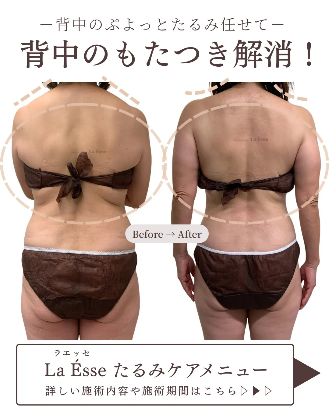 隠しきれない【年齢サイン】背中に出ていませんか？🥹 ぷよっと...