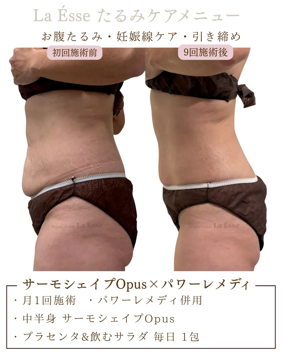 産後の中半身たるみを撃退👊🏻‼️ 妊娠線も引き締め◎