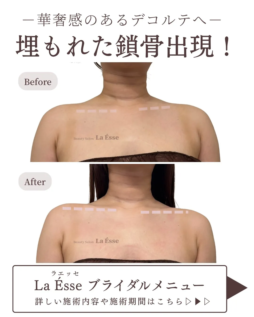 コリ解消で美しい鎖骨が現れる◎ 時間がない花嫁様にも💖