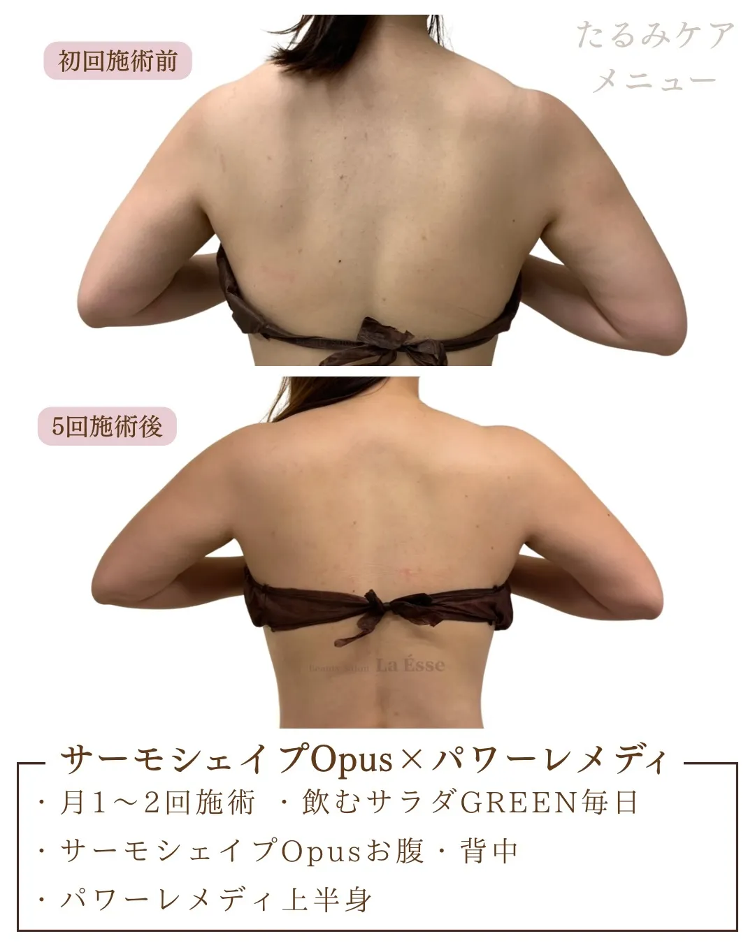 産後放置しがちの背中のたるみも若々しく引き締めちゃう💪🏻