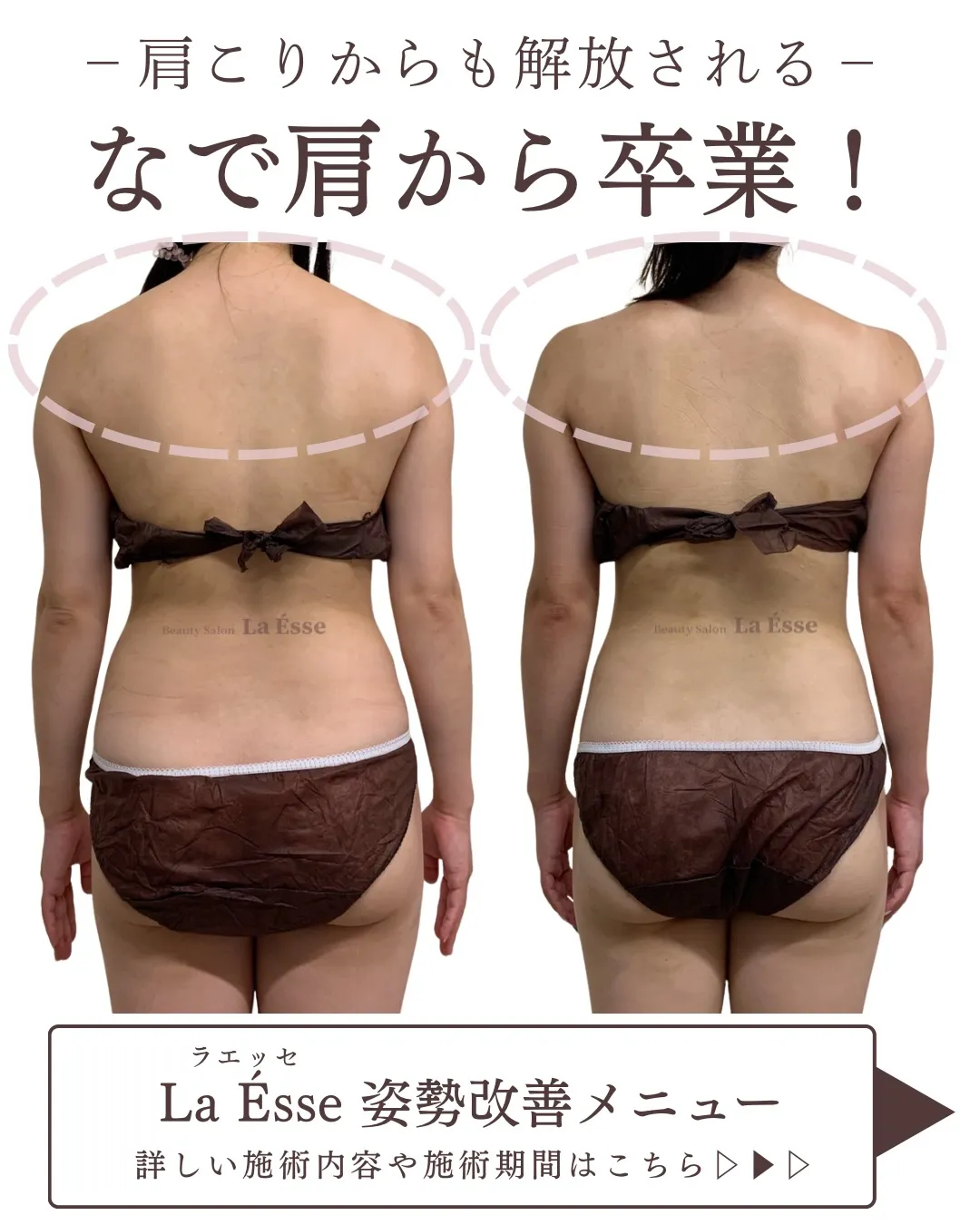 ３回筋膜リリースでなで肩から卒業へ✨ 背中スッキリ‼️