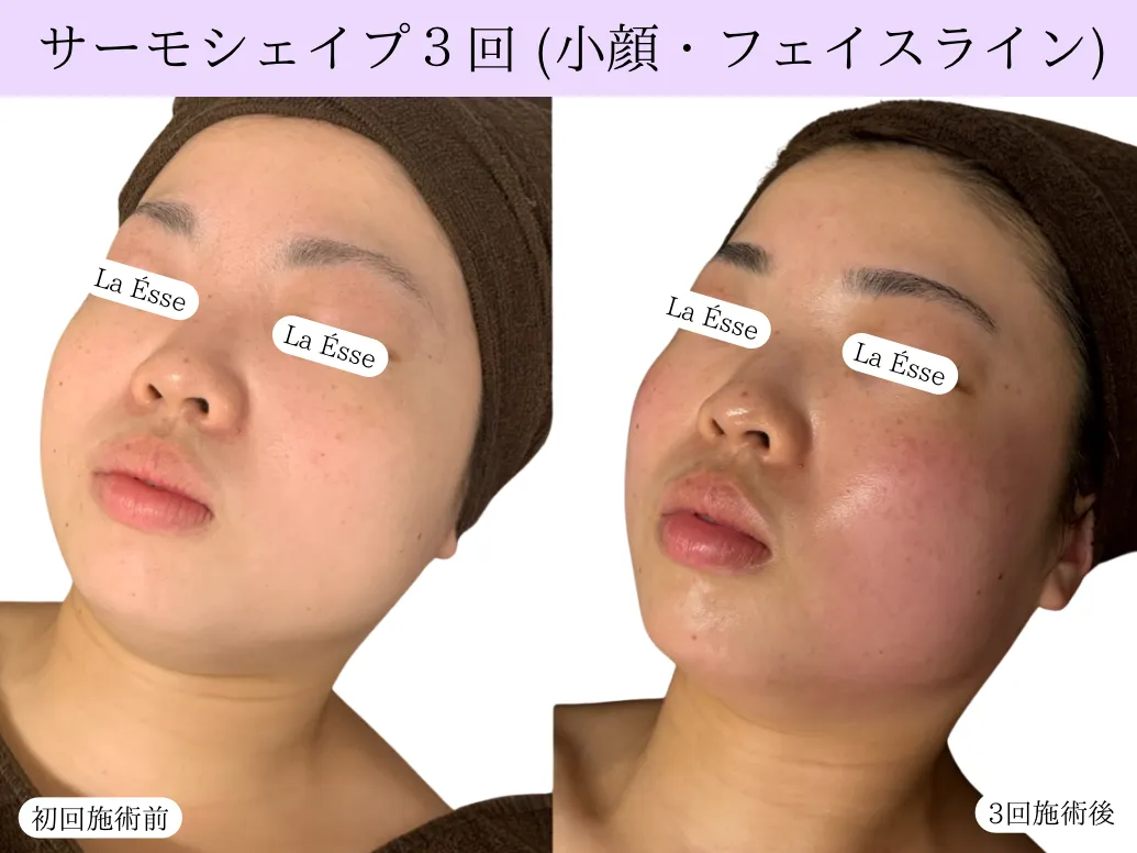 【小顔・たるみケア サーモシェイプ】