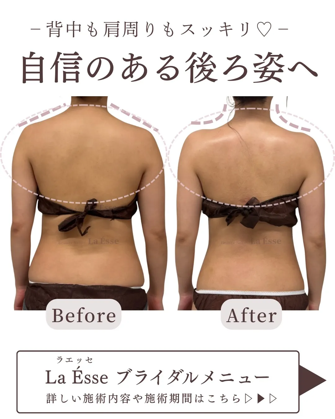 背中のモリっと感解消！スッキリした後ろ姿へ👰🏻‍♀️🩵