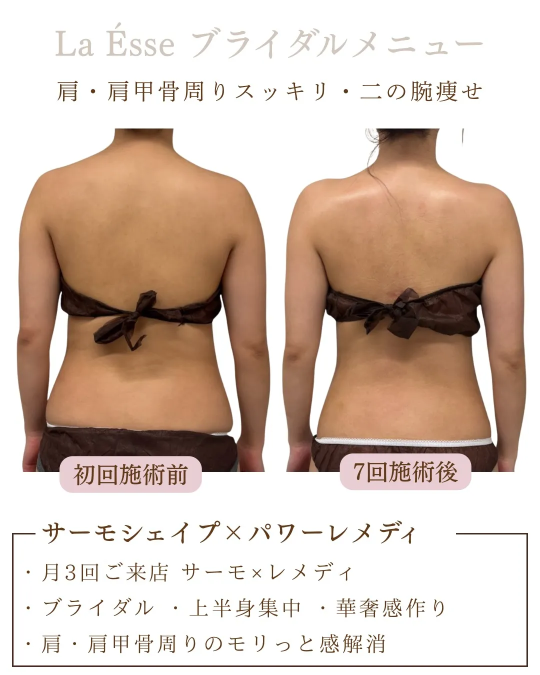 背中のモリっと感解消！スッキリした後ろ姿へ👰🏻‍♀️🩵