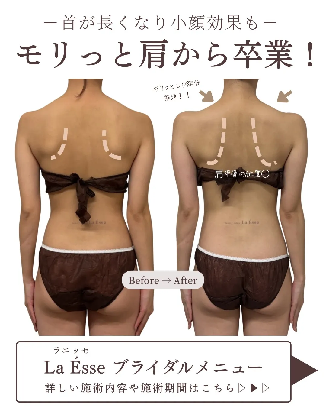 気になる肩のモリっと感を解消！ボトックスいらずの筋膜リリース...