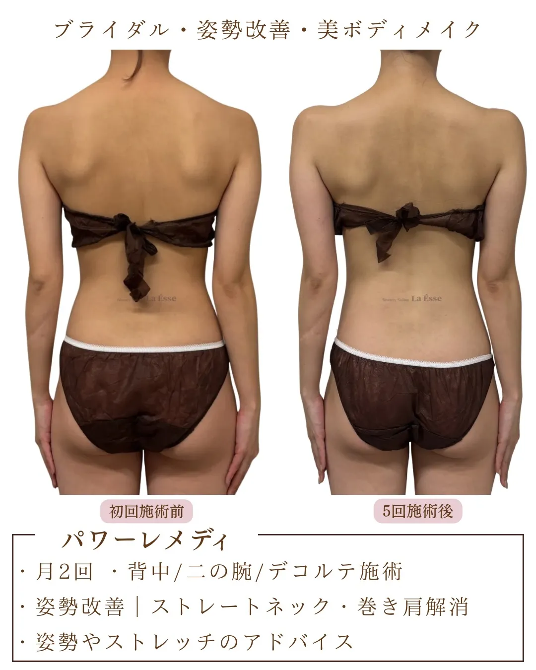 気になる肩のモリっと感を解消！ボトックスいらずの筋膜リリース...