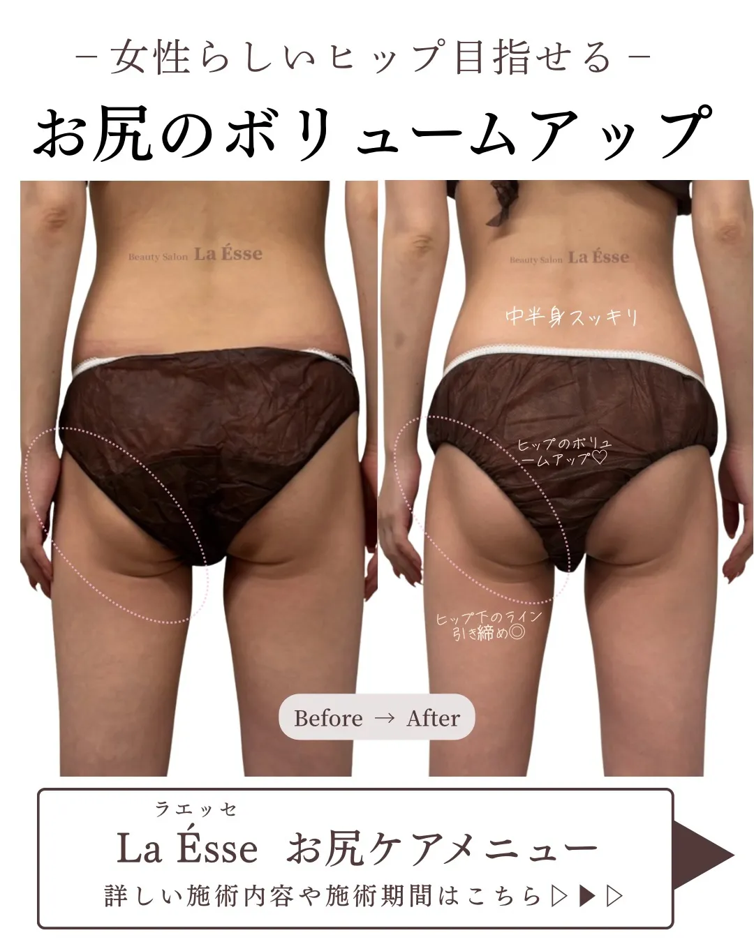 最新高周波で女性らしい丸みヒップGET🍑✨