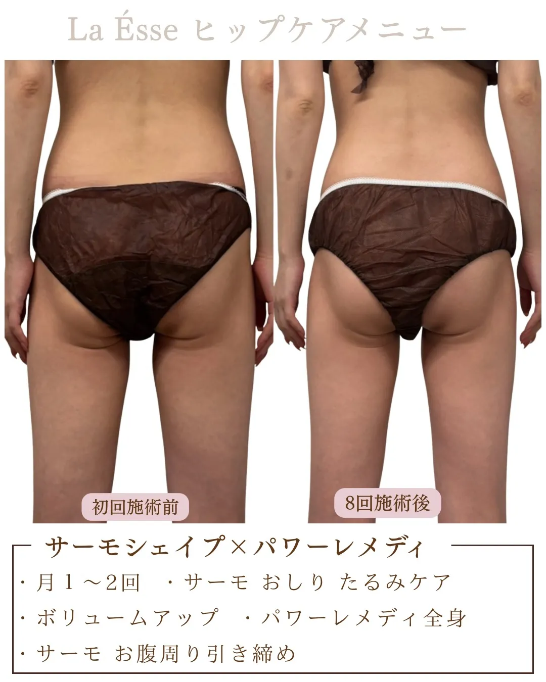最新高周波で女性らしい丸みヒップGET🍑✨