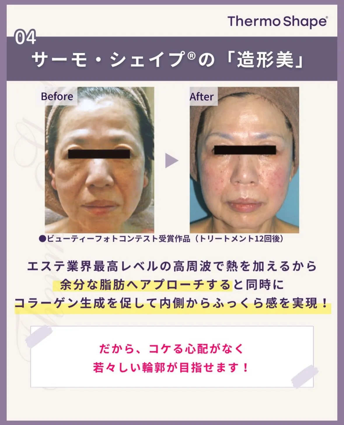 サーモシェイプで顔の印象を変えてさらに自信を💪🏻✨