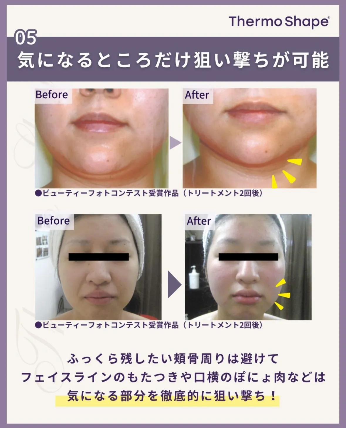 サーモシェイプで顔の印象を変えてさらに自信を💪🏻✨