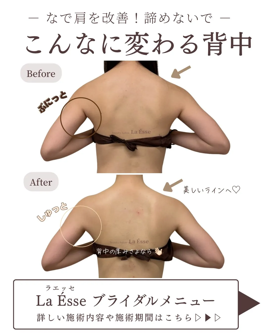 ボトックス💉をしなくても肩は美しく変わる🤝🏻✨