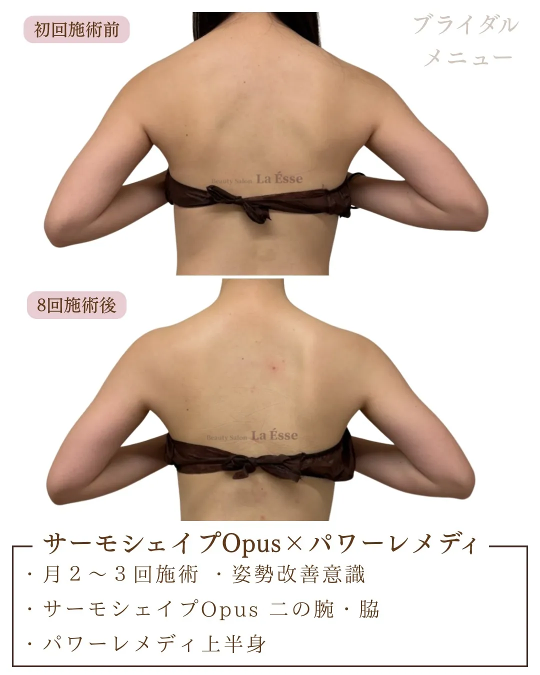 ボトックス💉をしなくても肩は美しく変わる🤝🏻✨